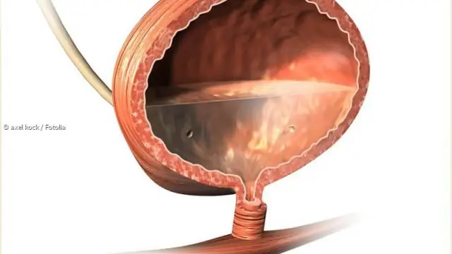 Дивертикулез: симптомы, причины, диагностика, лечение, профилактика