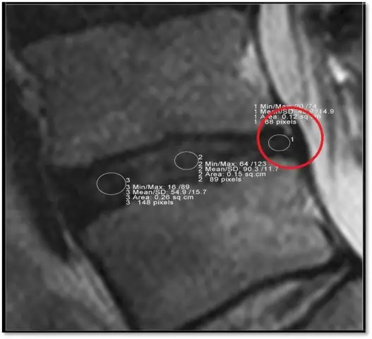 Вопросы о боли в шее и заболеваниях шейного диска