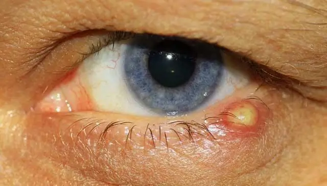 Ячмень заразен? Причины, симптомы, лечение, & профилактика