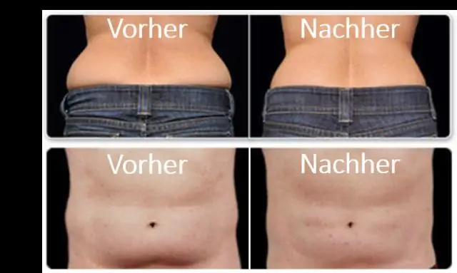 МРТ плеча: процедура, результаты и многое другое