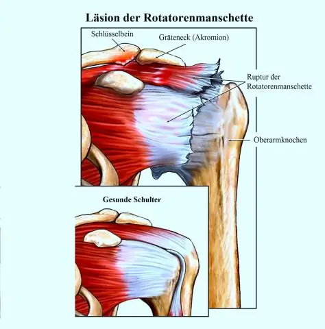 Тендинопатия вращательной манжеты плеча: симптомы, диагностика, лечение
