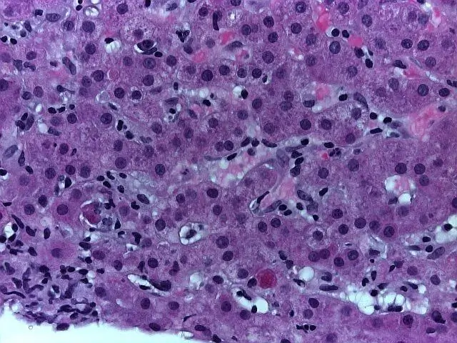 Каковы баллы MELD и Чайлд-Пью для заболевания печени?