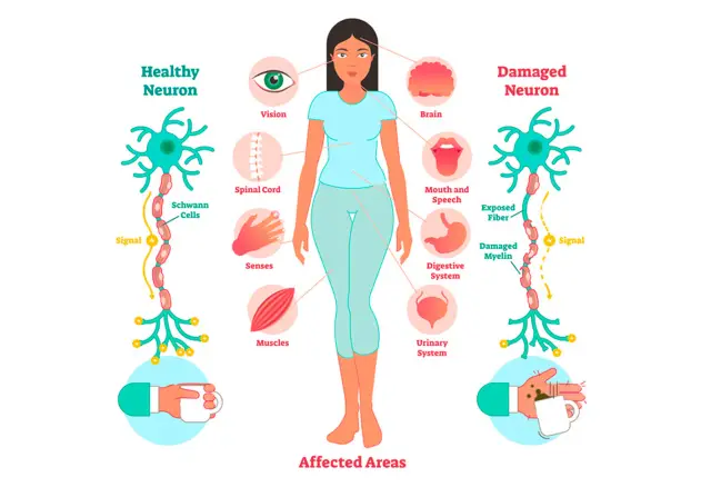 Боль при рассеянном склерозе: почему рассеянный склероз вызывает боль & Что с этим делать