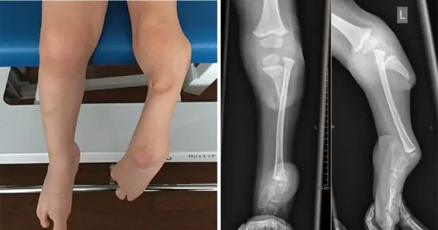 Врожденный гипотрихоз: врожденная аплазия, треугольная алопеция и др