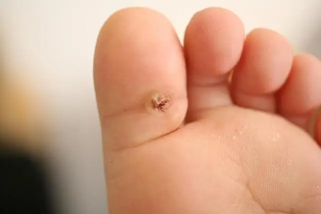 Экзема: как определить и вылечить экзему на сосках