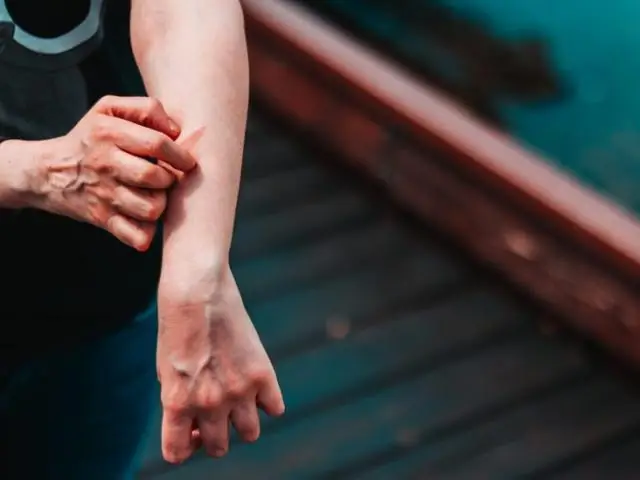 Ксеротическая экзема: что это такое, что вызывает ее и как ее лечить