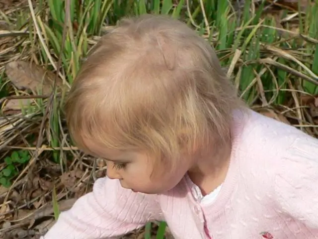 Дефекты волосяного стержня: синдром рыхлого анагена, чрезмерная обработка, удаление кутикулы