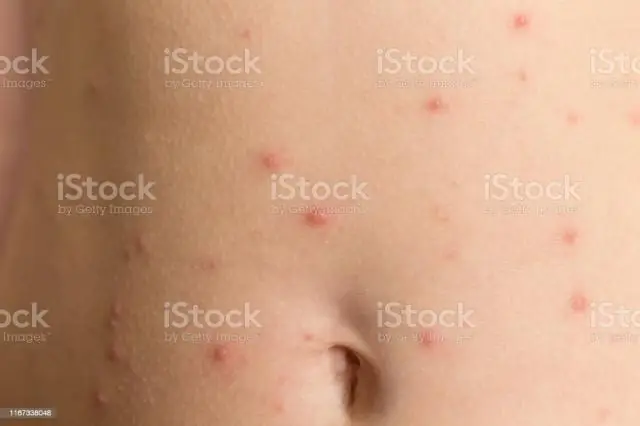 Tinea Nigra: симптомы, причины, лечение и многое другое