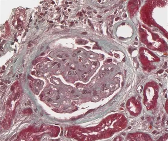 IgA-нефропатия - нефритическая или нефротическая?