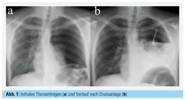 Где вы выслушиваете верхушечный пульс?