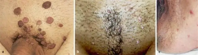 Моллюск - это ЗППП?