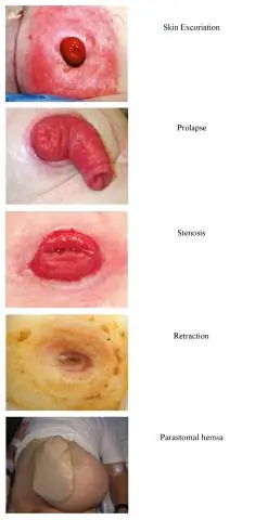 Что такое стеноз стомы?