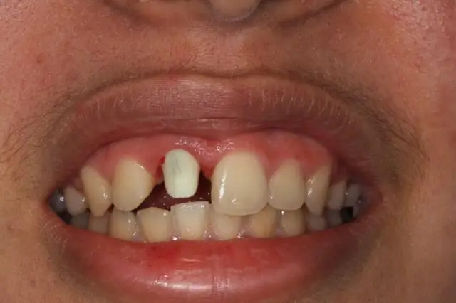 Сколько стоят зубные имплантаты в Орегоне?