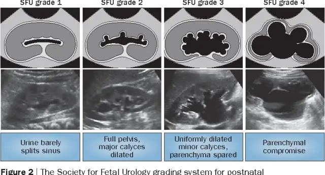 Что означает гидронефроз в медицине?