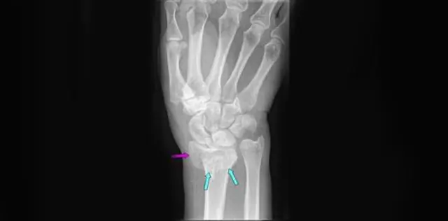 Где находится дистальный радиус лучевой кости?