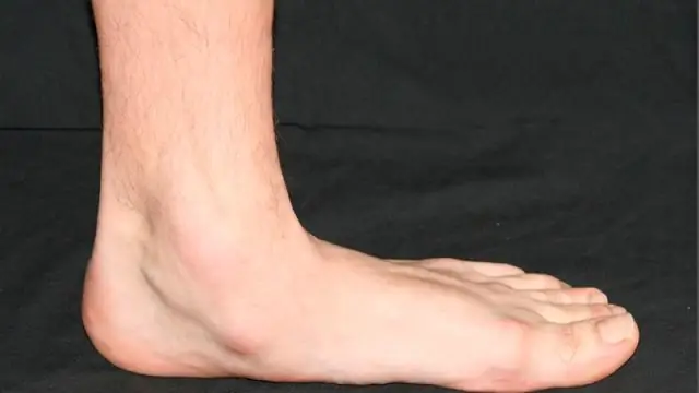 Что такое нормальный выход илеостомы?