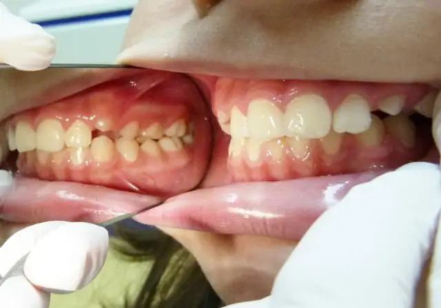 Что вызывает аускультативный разрыв?