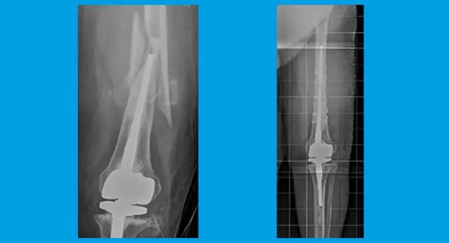 Что такое псевдоартроз голени?