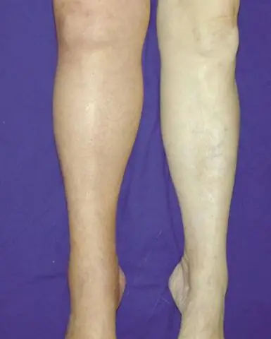 Что такое терапевтическое ЧТВ при гепарине?