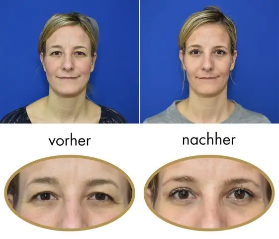 Как долго заживают разрез и дренаж?