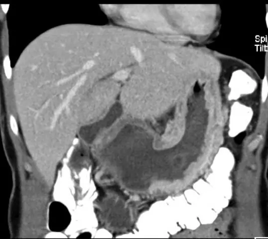 Этапная лапароскопия и цитология брюшины у пациентов с аденокарциномой желудка ранней стадии