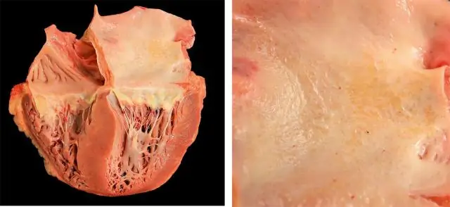 Прогрессирующее поражение хориоретинала у пациента с амилоидозом легкой цепи (AL): история болезни