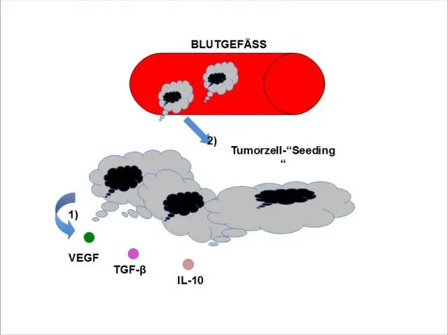 Метастатическое поведение и общая выживаемость в зависимости от подтипов рака молочной железы на стадии IV воспалительного рака молочной железы