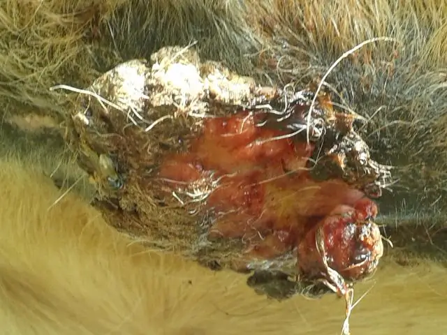 Саркомы при наследственной ретинобластоме