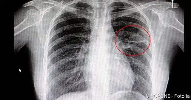Серия лобулярного рака молочной железы: визуализация