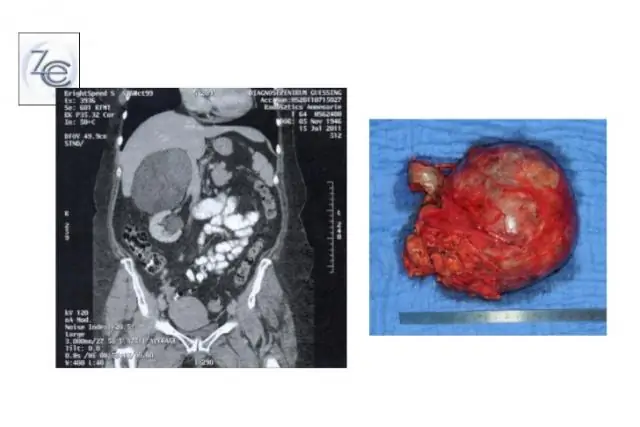 Размер и распространенность аллеля FMR1 CGG, выявленные при скрининге новорожденных в США