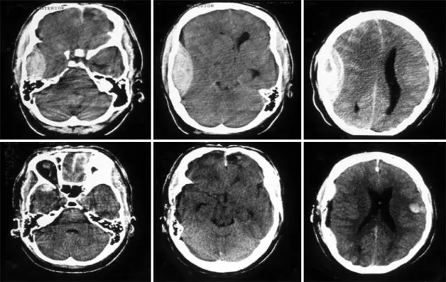 Декомпрессивная краниэктомия при остром ишемическом инсульте