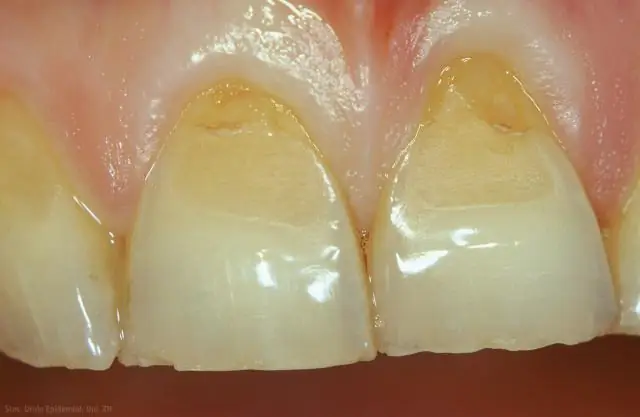 Устные, замороженные капсулы фекальной микробиоты с трансплантатом (FMT) для рецидивирующей инфекции Clostridium Difficile