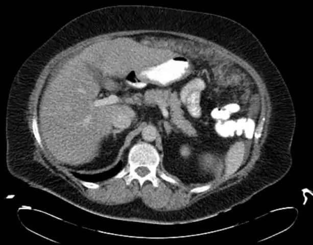 Связанная со статинами слабость при миастении: история болезни