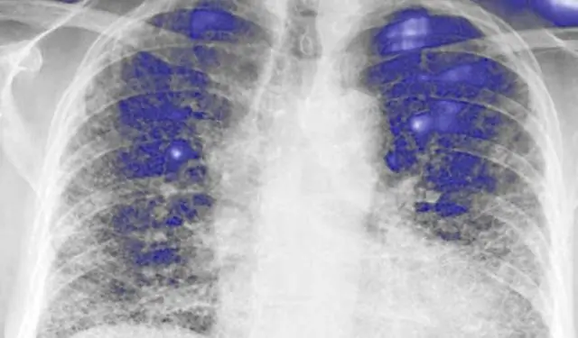 Лечение идиопатического легочного фиброза: сетевой метаанализ