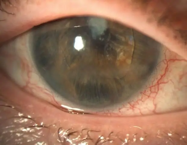 Компенсация роговицы пресбиопии: PresbyLASIK: обновленный обзор