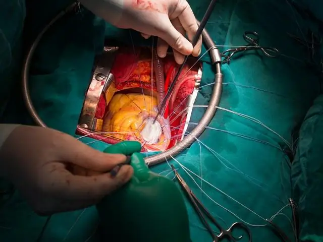 Повреждение кортикоспинального тракта при синдроме ХГЧ: метаболическая причина наследственной спастической параплегии