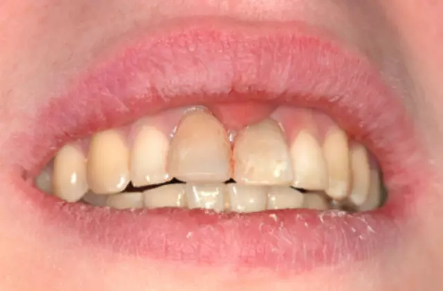 Потенциальное использование клинических полигенных оценок риска в психиатрии - этические последствия и информирование о высоком полигенном риске