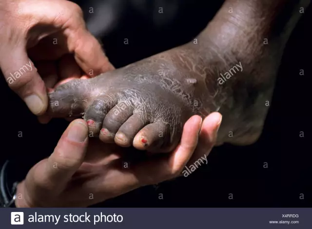 Оценка воздействия лечения на лимфатический филяриатоз в 13 округах Бенина: прогресс в элиминации в девяти округах, несмотря на сохранение передачи в некоторых районах