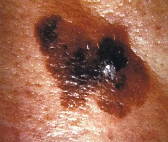 Мона Сарайя, MD, MPH, отдела CDC по профилактике и контролю рака