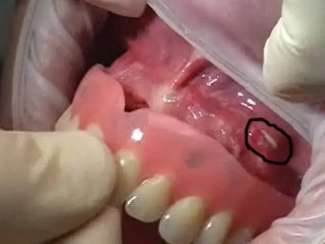 ВПЧ-ассоциированная диагностика рака по возрасту