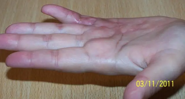 Национальная статистика Текстовые описания - Данные и статистика - Артрит