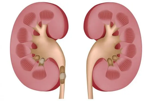 Всемирный день почек г., камни в почках, хроническая болезнь почек, дефицит железа и атеросклероз
