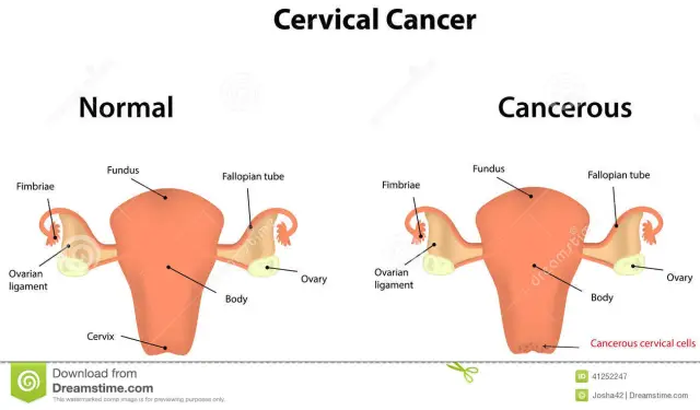 Что такое рак шейки матки? Симптомы, причины, диагностика, лечение и профилактика