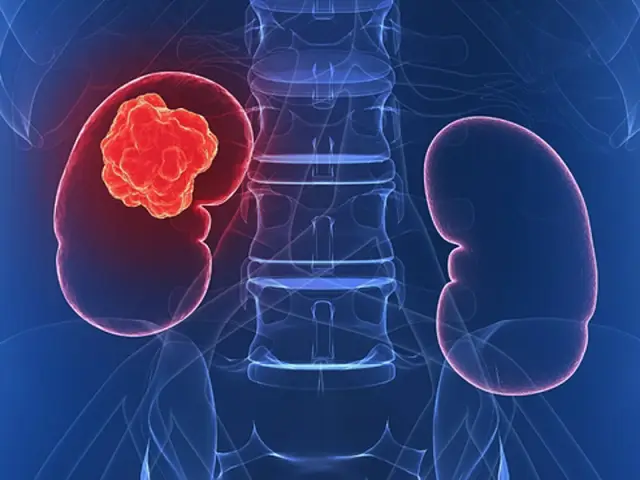 Что такое рак почки? Симптомы, причины, диагностика, лечение и профилактика