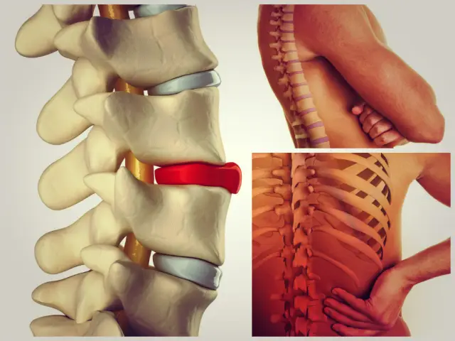 Каковы симптомы грыжи и как ее диагностировать?