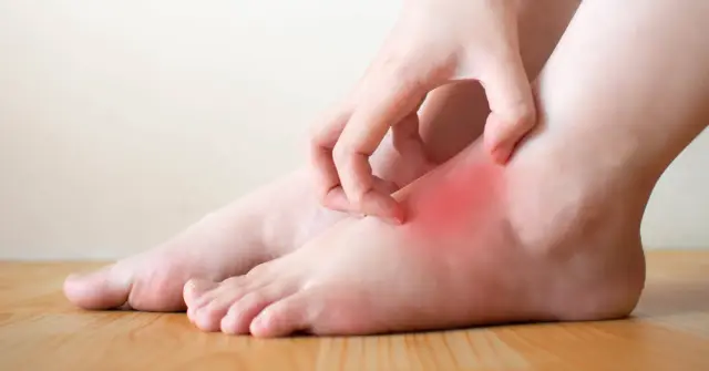 Что такое эпидермофития стопы? Симптомы, причины, диагностика, лечение и профилактика