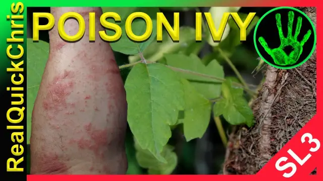 Что такое ядовитый плющ? Симптомы, причины, диагностика, лечение и профилактика