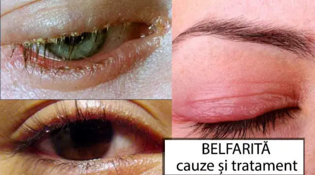 Что такое блефарит? Симптомы, причины, диагностика, лечение и профилактика