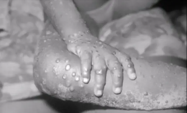 Смерти после употребления листериозных дынь