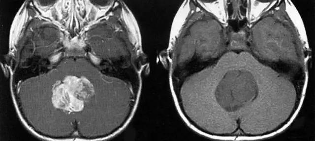 Излучение сотового телефона как фактор риска опухолей головного мозга